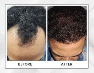 Dr. Dermat Advanced Hair Treatment